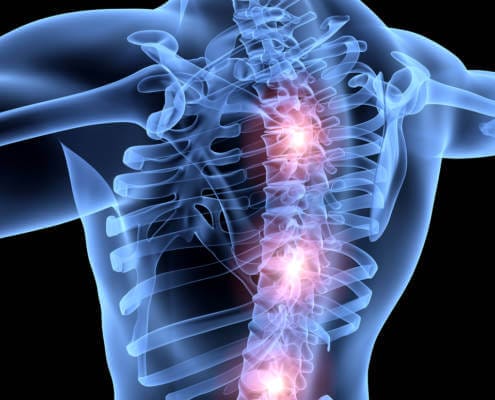 What is a herniated disc and will workers’ comp in Florida cover this injury?